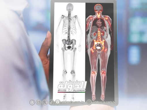 لأول مرة  في ليبيا.. إنتاج مادة تستخدم لتشخيص أورام العظام بدقة عالية